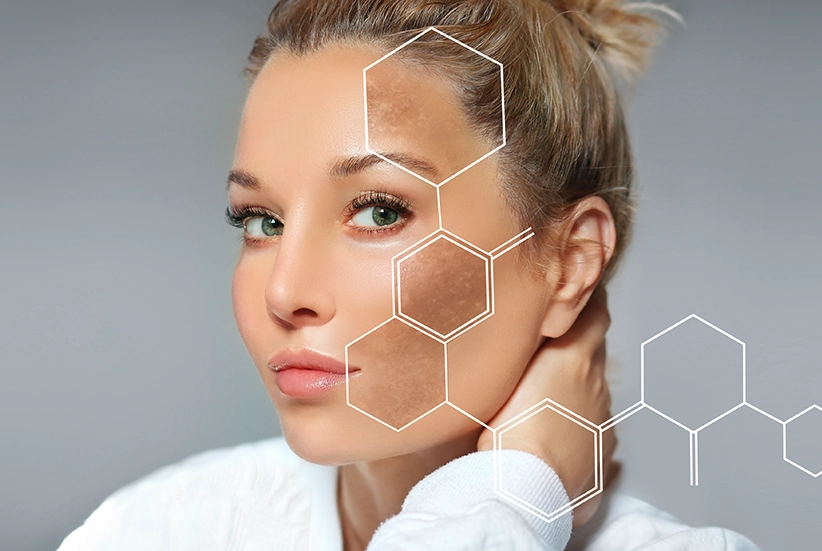Manchas e melasma
