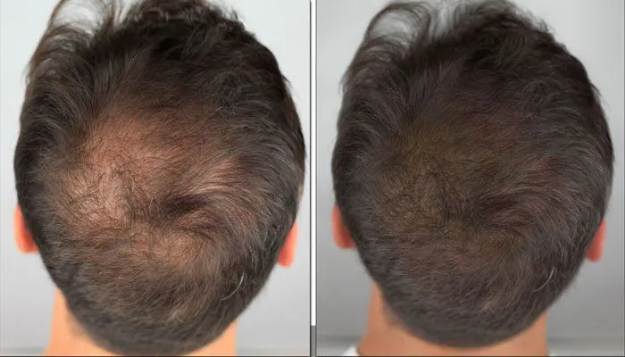Antes e depois do tratamento capilar
