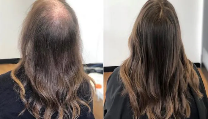 Antes e depois do tratamento capilar