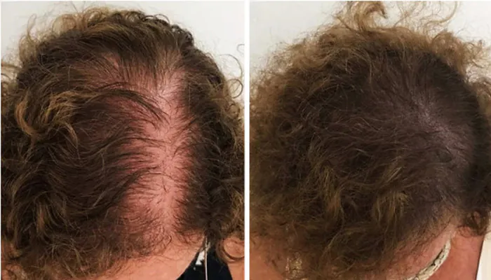 Antes e depois do tratamento capilar