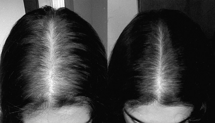 Antes e depois do tratamento capilar